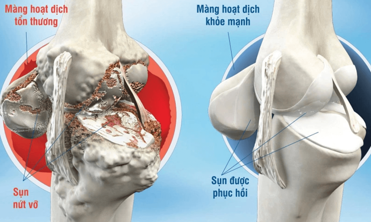 Cảnh báo thoái hóa khớp gối háng cột sống gây đau tàn phế - ảnh 1